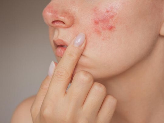 Nadwrażliwość na kosmetyki – jak wybrać odpowiednie produkty dla skóry z trądzikiem różowatym?